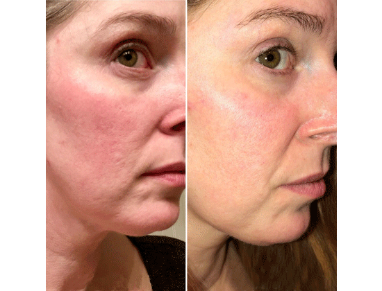 cea mai bună rutină a pielii pentru anti-îmbătrânire cel mai bun demachiant facial acnee anti-imbatranire